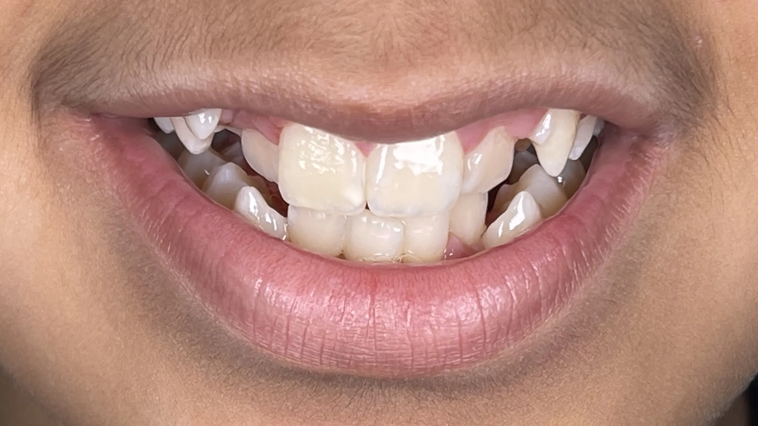 Best Orthodontist In Jumeirah, Dubai 15 dental crowding
