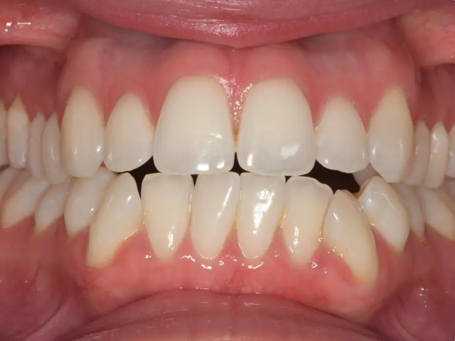 Best Orthodontist In Jumeirah, Dubai 19 dental crowding