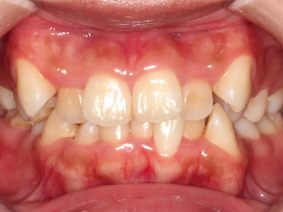 Best Orthodontist In Jumeirah, Dubai 21 severe crowding