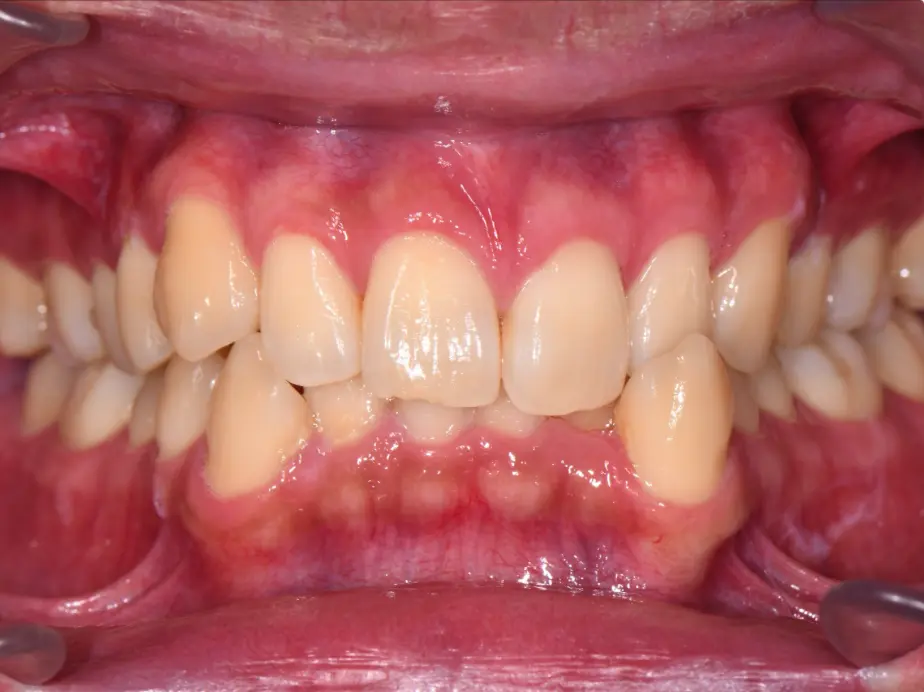 Best Orthodontist In Jumeirah, Dubai 23 dental crowding