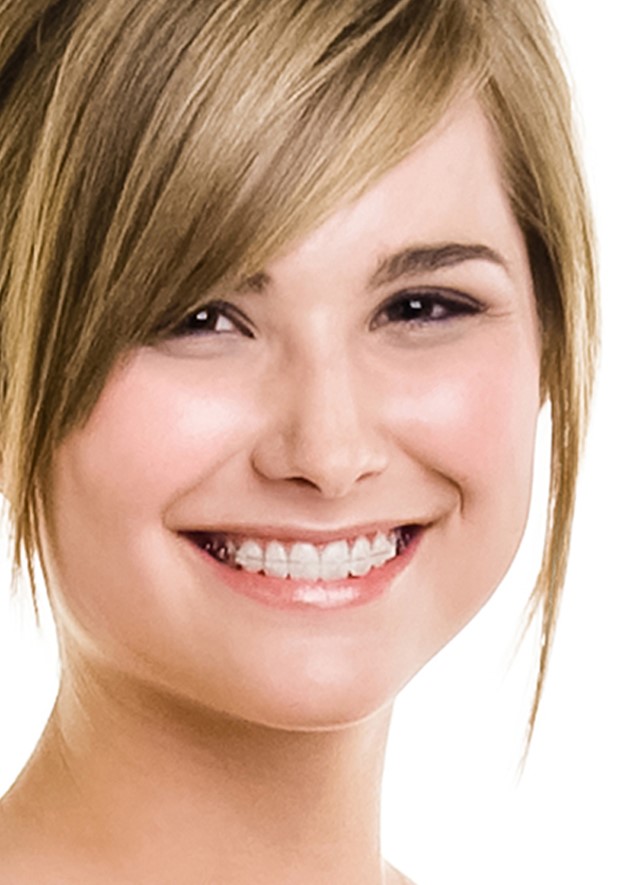 Best Orthodontist In Jumeirah, Dubai 32 Damon Self Ligating System